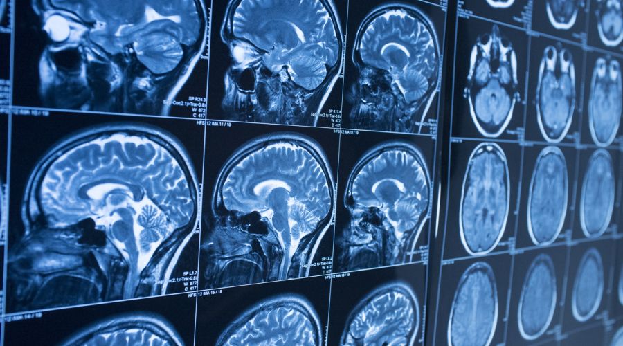 aptaTargets makes strides in treatment for stroke patients